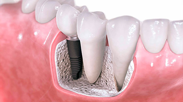 Implantes Dentales Implantes Dentales